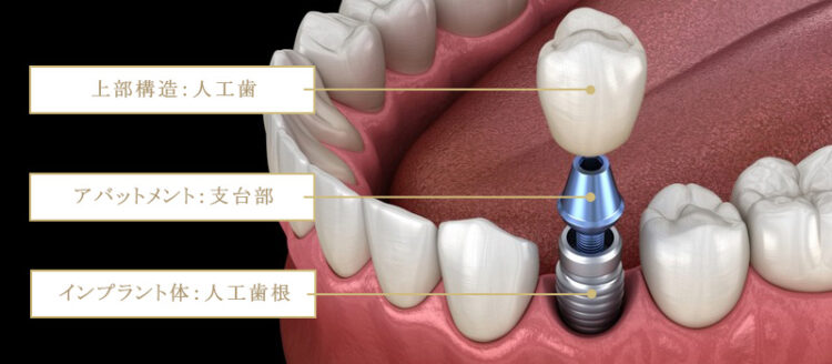 インプラントのパーツ説明