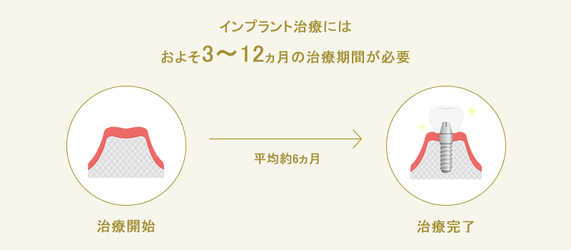 インプラントの治療開始から完了までのイメージ図