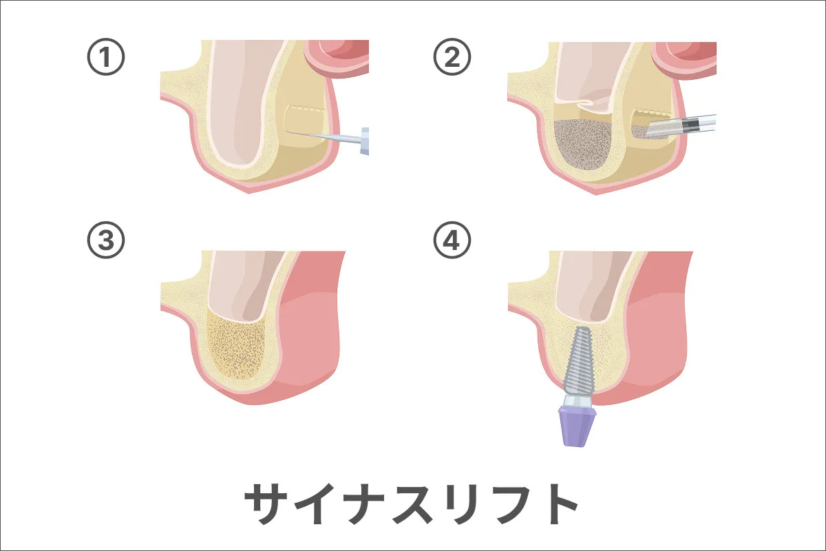 サイナスリフトのイメージ