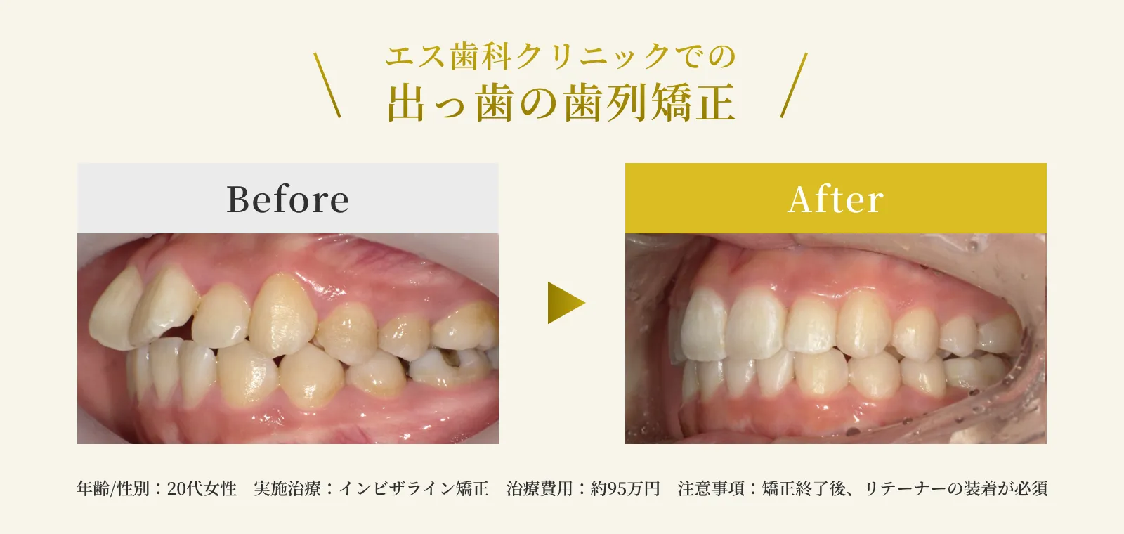 エス歯科クリニックでの出っ歯の歯列矯正