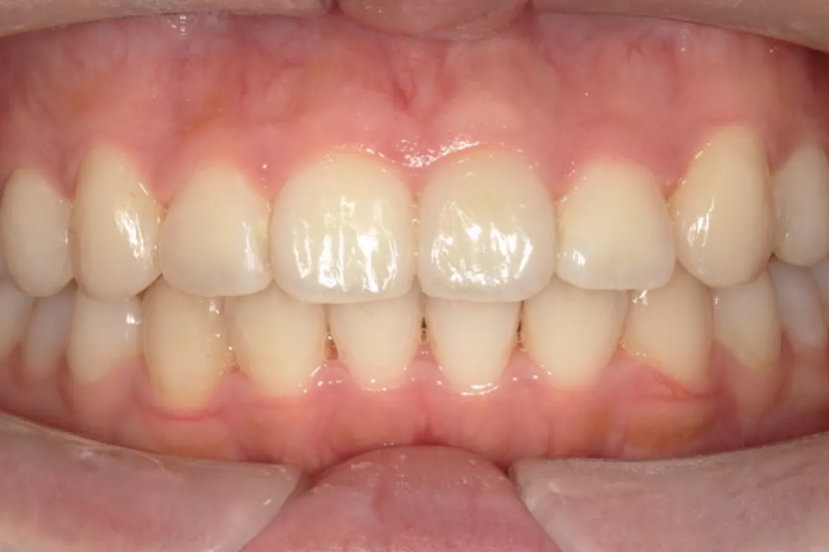 After Image