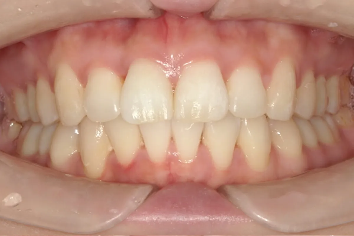 After Image
