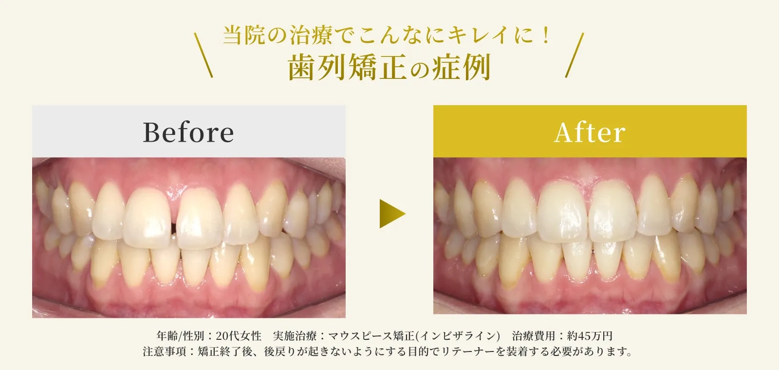 エス歯科クリニックの部分矯正の症例